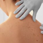 Discover the Splendor X: Transforming Laser Hair Removal at Wow Laser, Hallandale FL